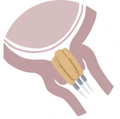 Preparing your cervix