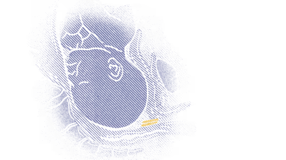 The cervix gradually and predictably softens and dilates, preparing the mother for the next step in induction of labour