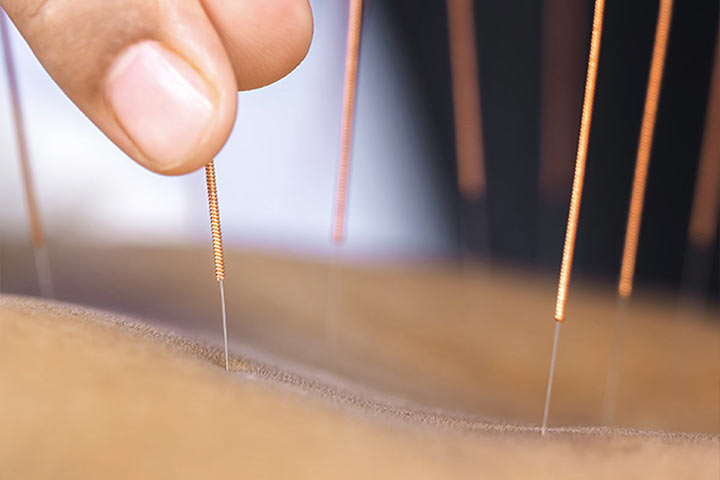 Akupunktura w HOLISTIC MED™