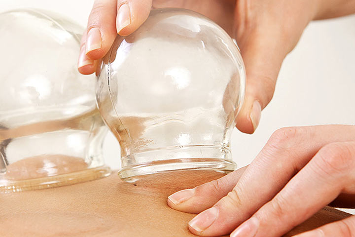 Bańki Chińskie w HOLISTIC MED™