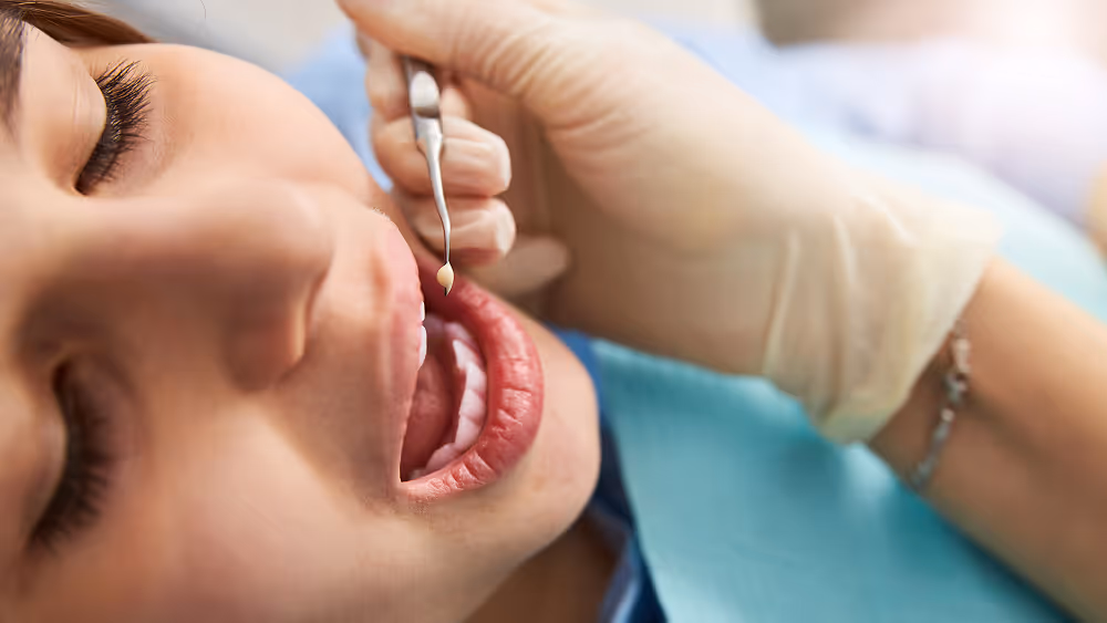 Before and after tooth-colored composite filling in Pasadena dental office