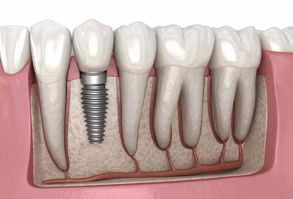 Dental Implants