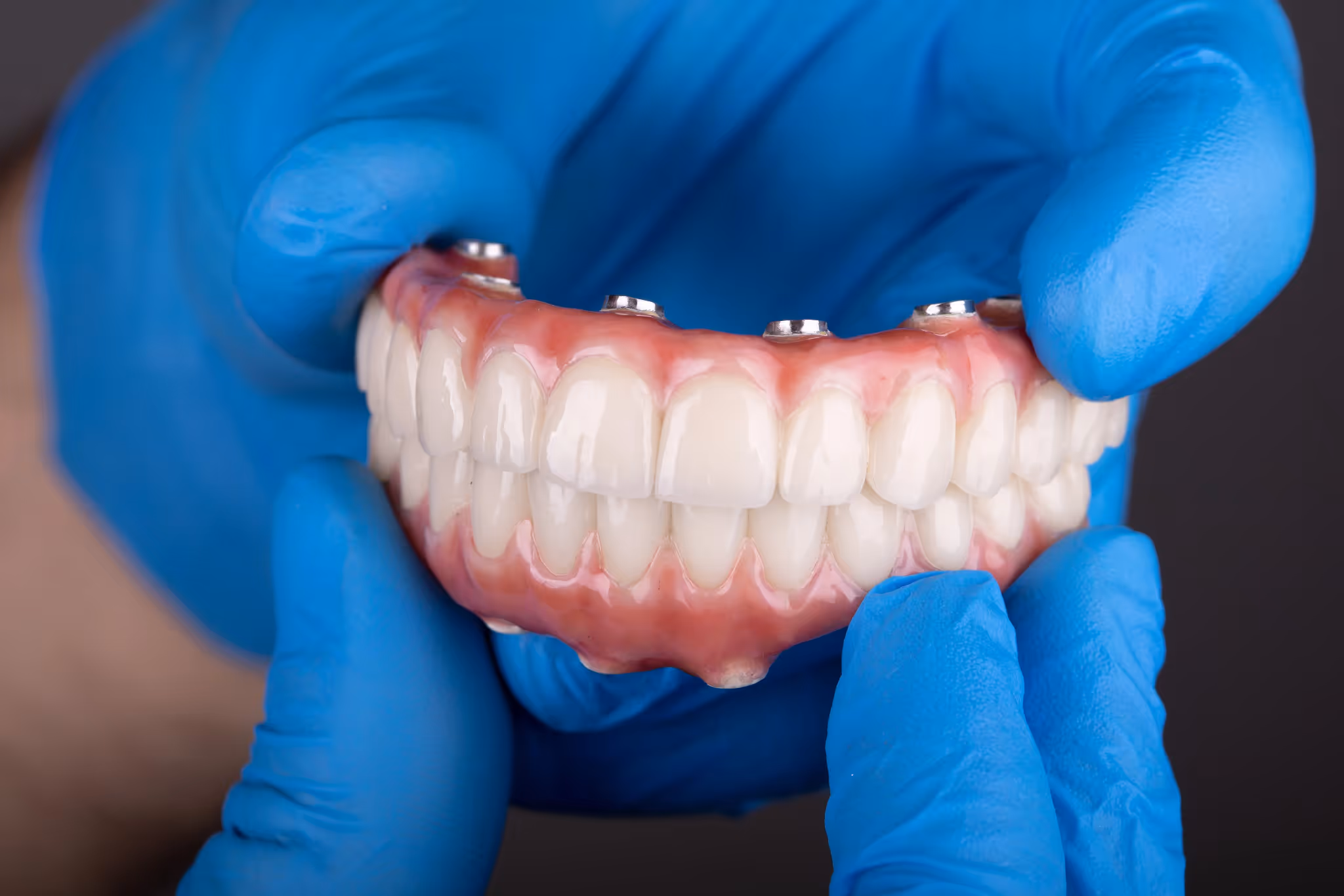 Full Mouth Dental Implants at Legacy