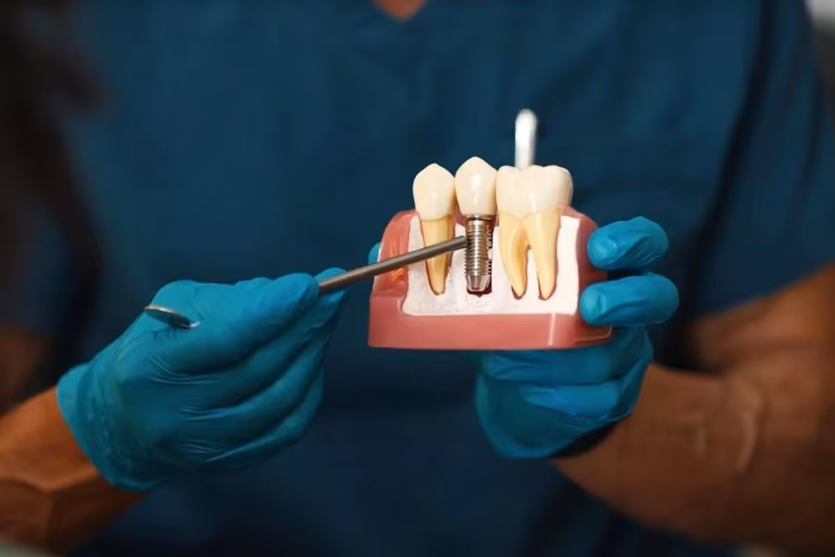 Many factors influence the cost of dental implants