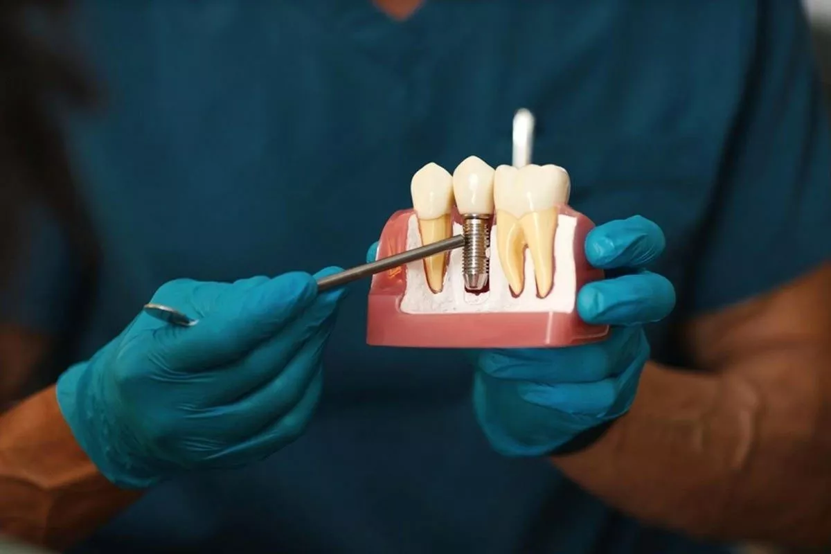 Many factors influence the cost of dental implants