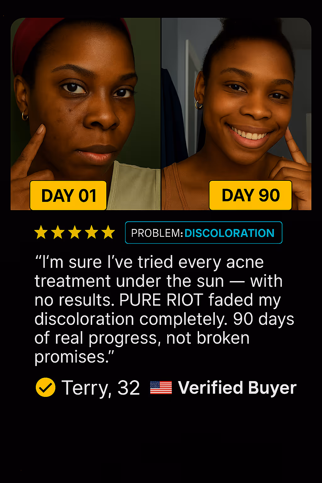 Side-by-side photos of a woman on Day 01 with acne discoloration and on Day 90 with clear skin, accompanied by a testimonial praising PureRiot's effectiveness in fading discoloration.