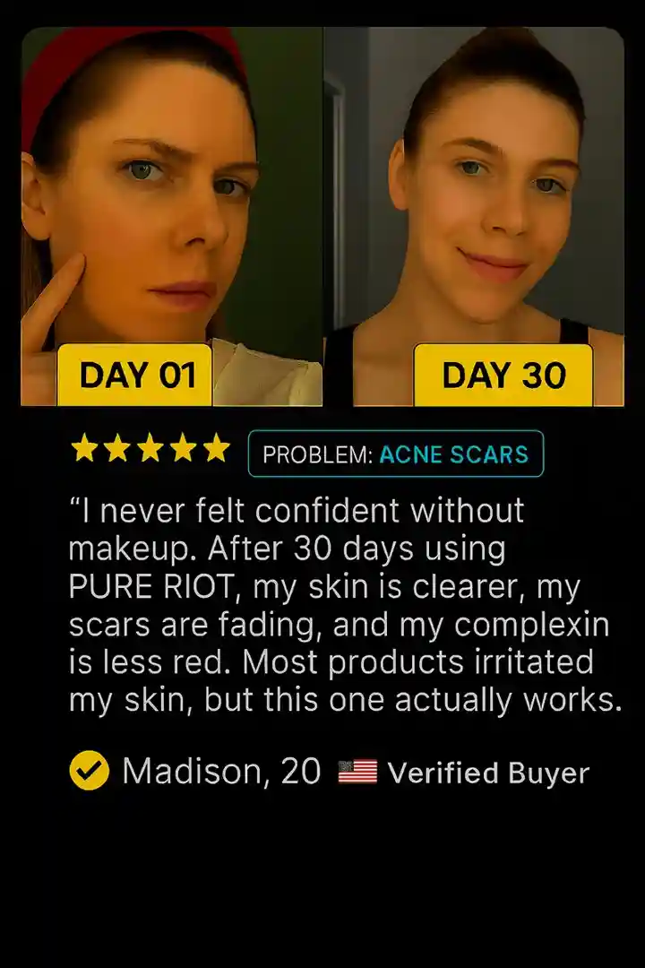 A 4-week before and after progression for fine lines, showing gradual softening and reduction - diy microneedling before and after A 4-week before and after progression for fine lines, showing gradual softening and reduction - diy microneedling before and after