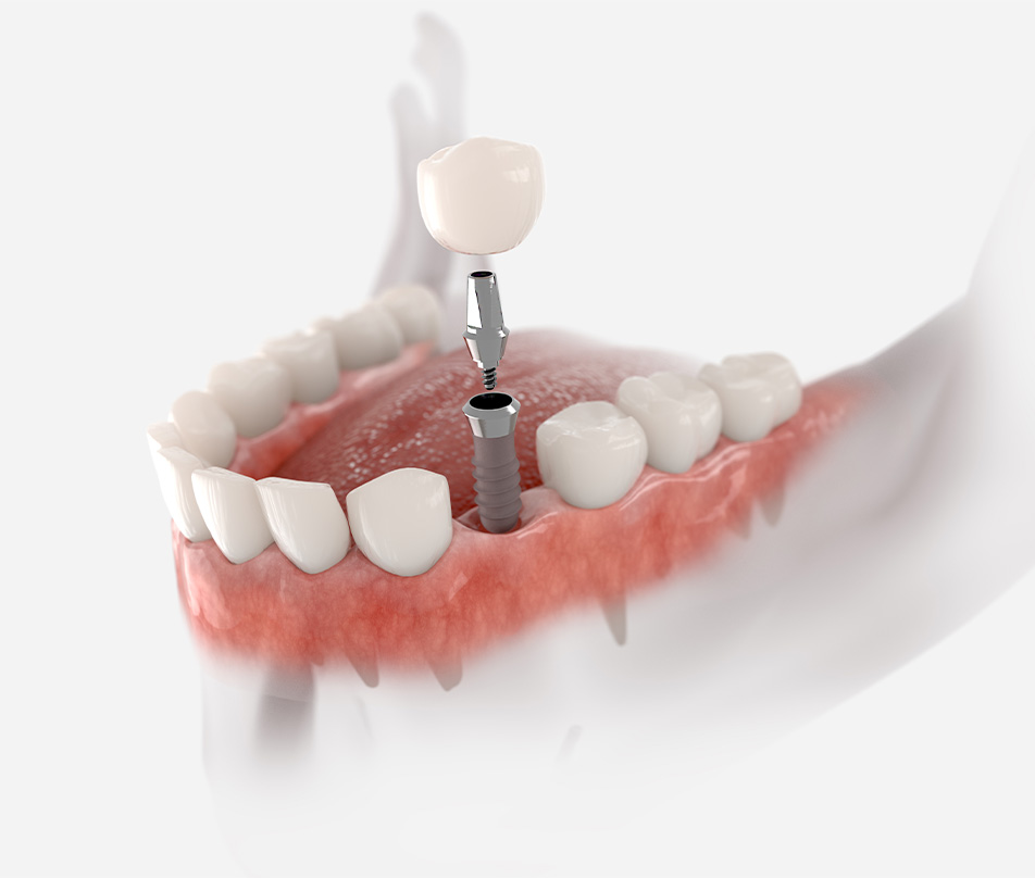 Dental implant crowns