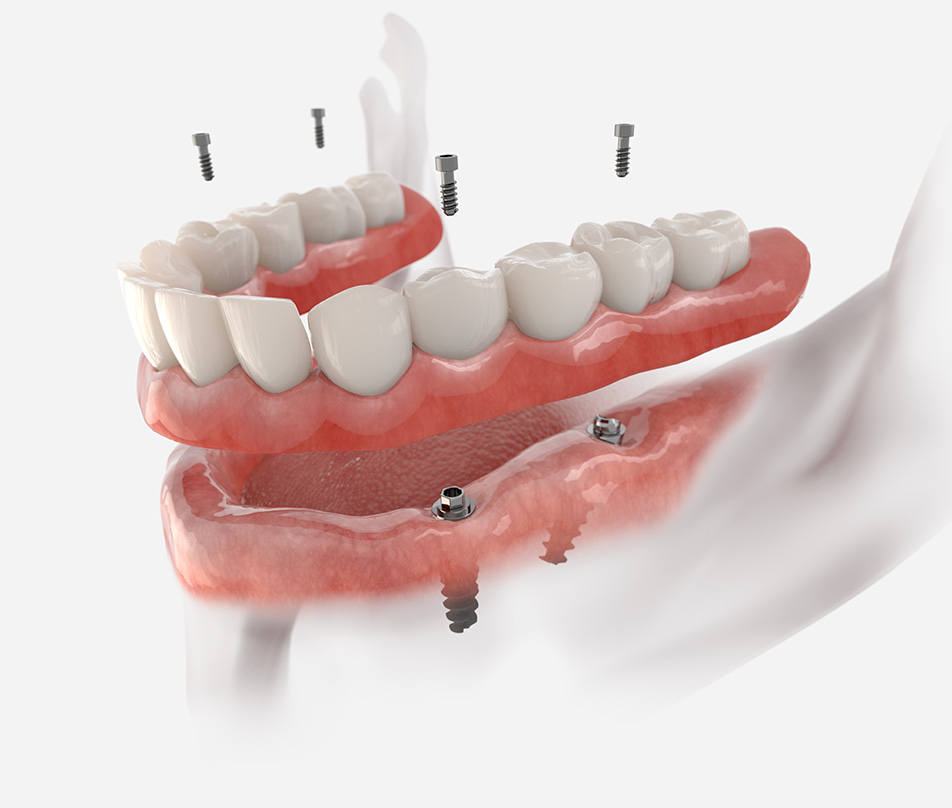 Dental implant dentures