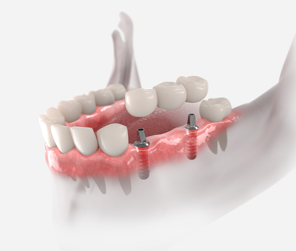 Dental implant bridges
