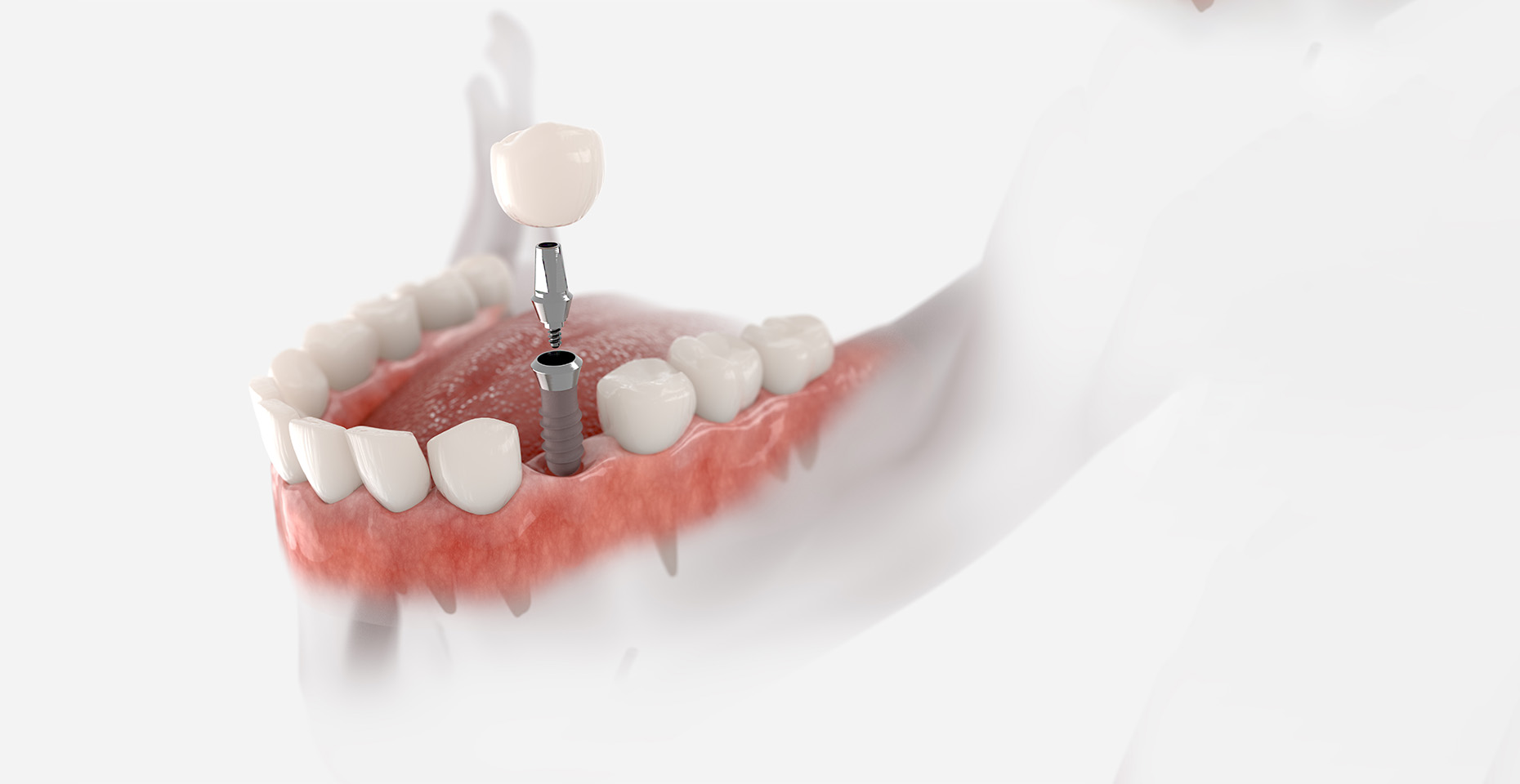 Dental implant crowns