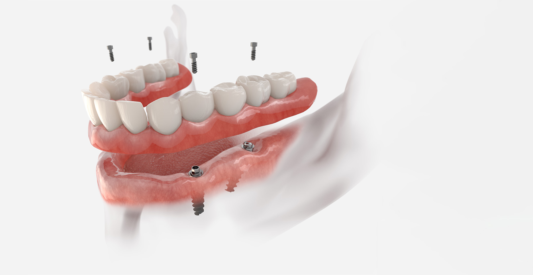 Dental implant dentures