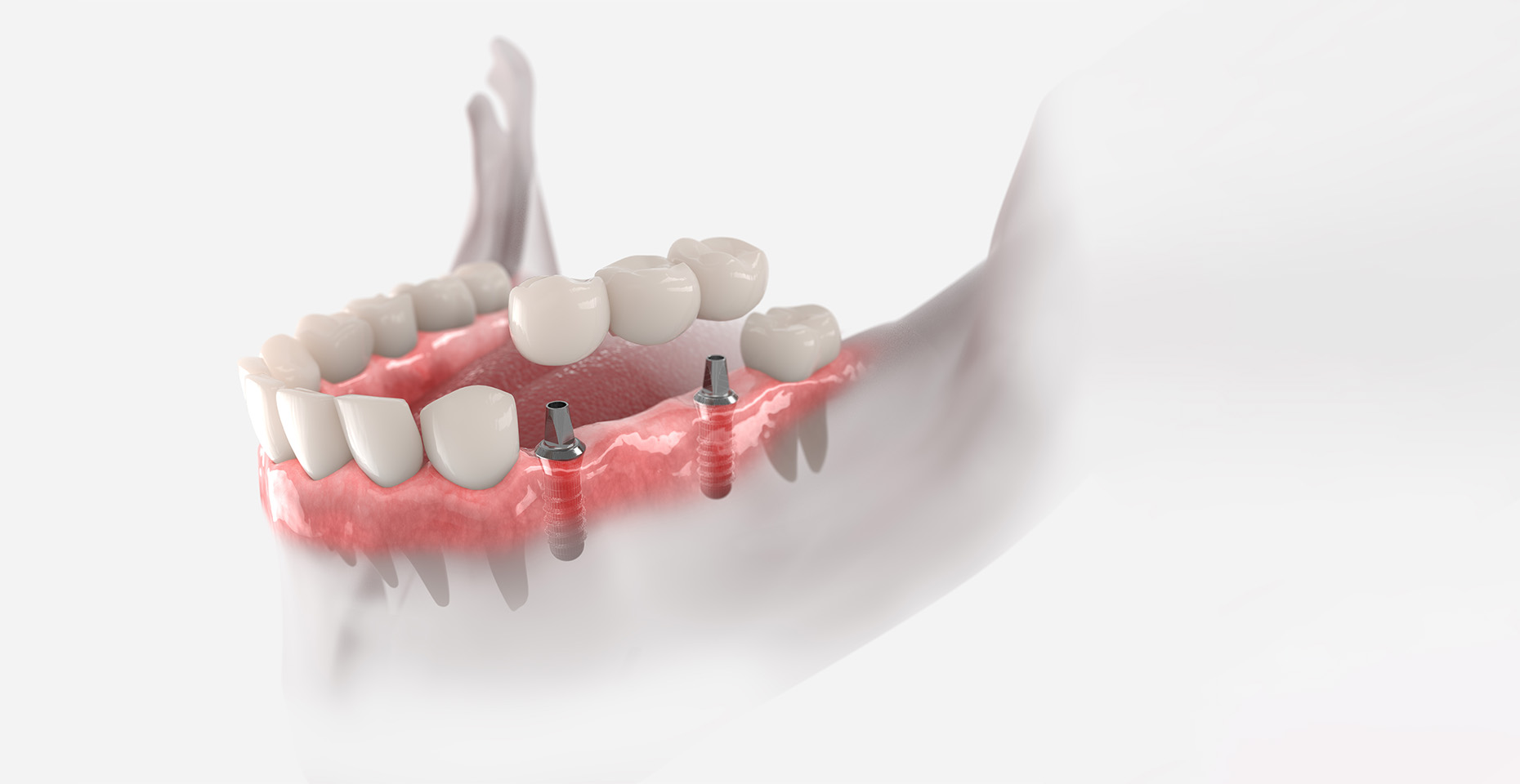 Dental implant bridges