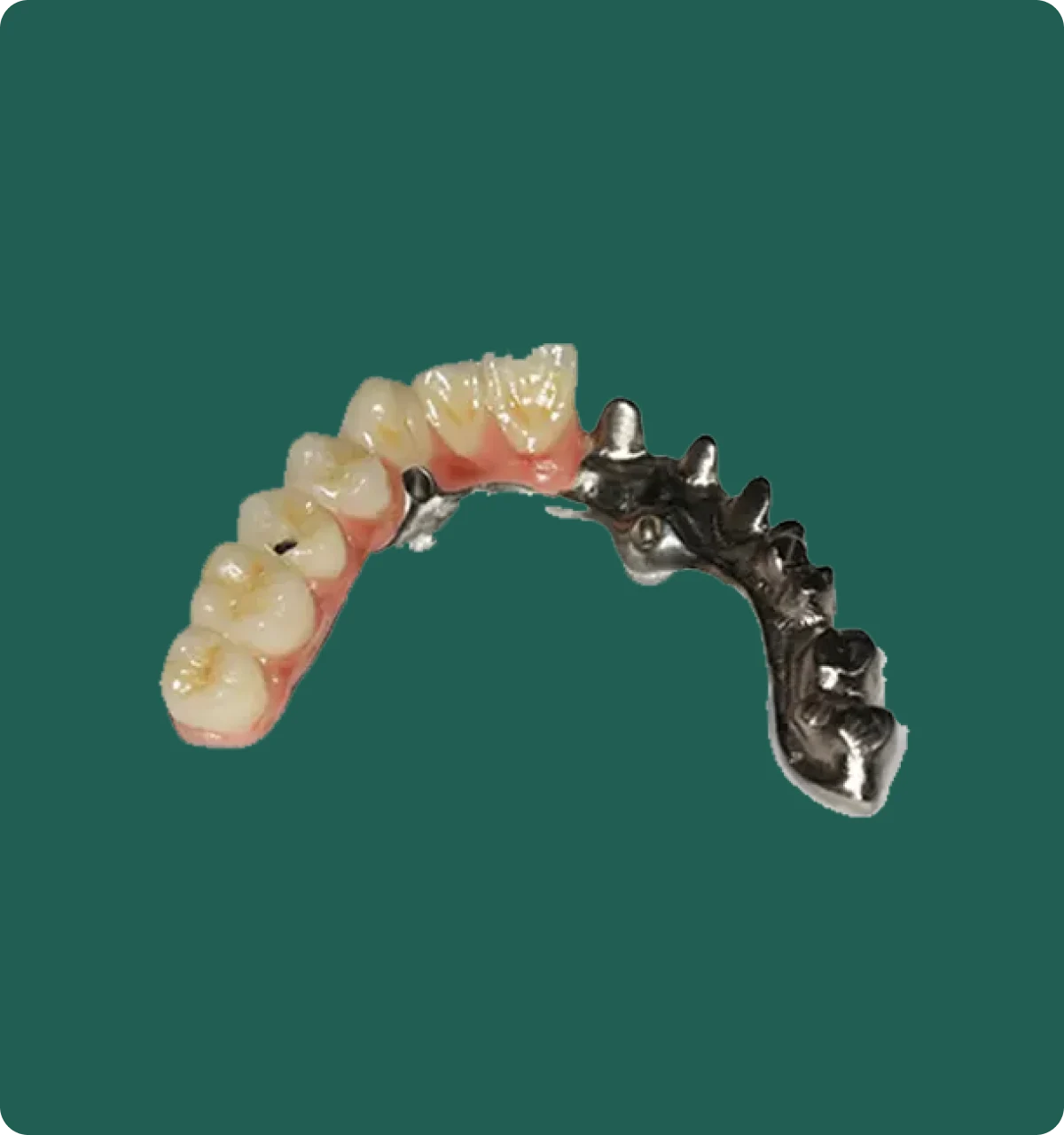 Underside view of a Toronto bridge prosthesis showing the Malo bridge framework and implant attachment points.