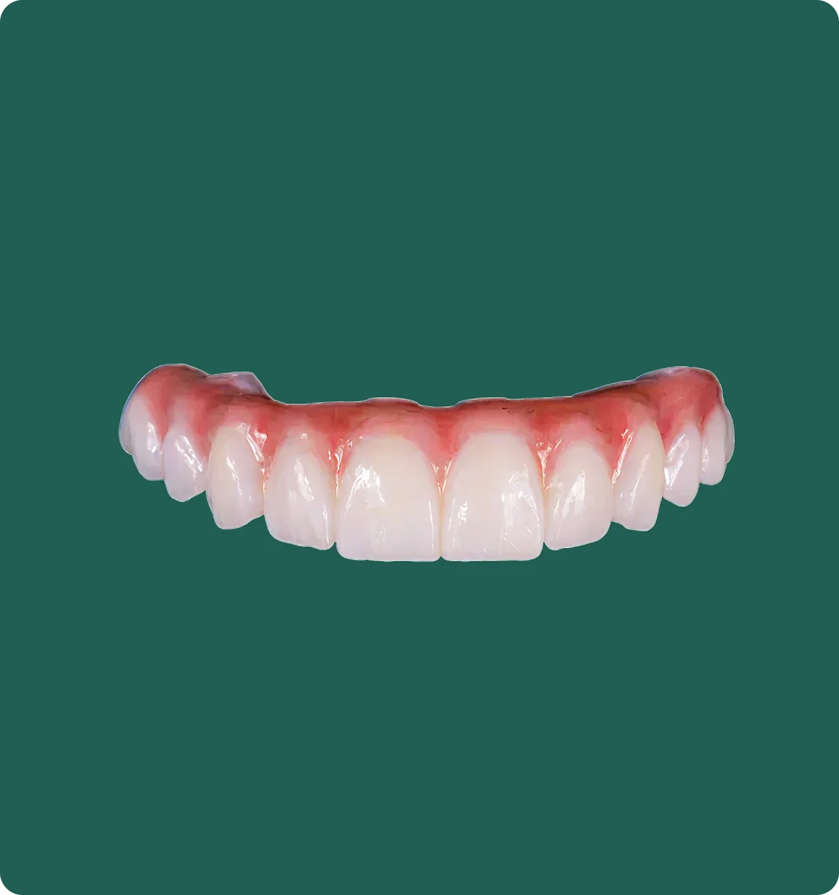 Close-up of an All-on-X zirconia bridge showing natural tooth translucency and layered shading.