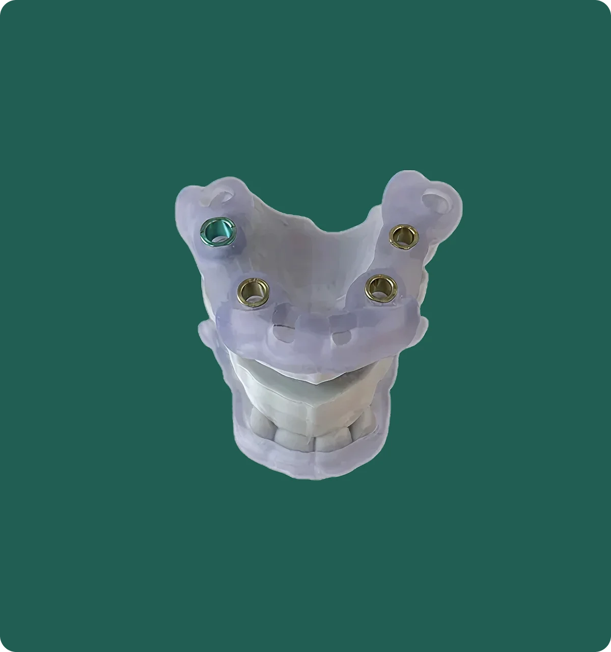 Surgical guide positioned on a dental model, showing drill sleeve channels used for guided implant surgery.