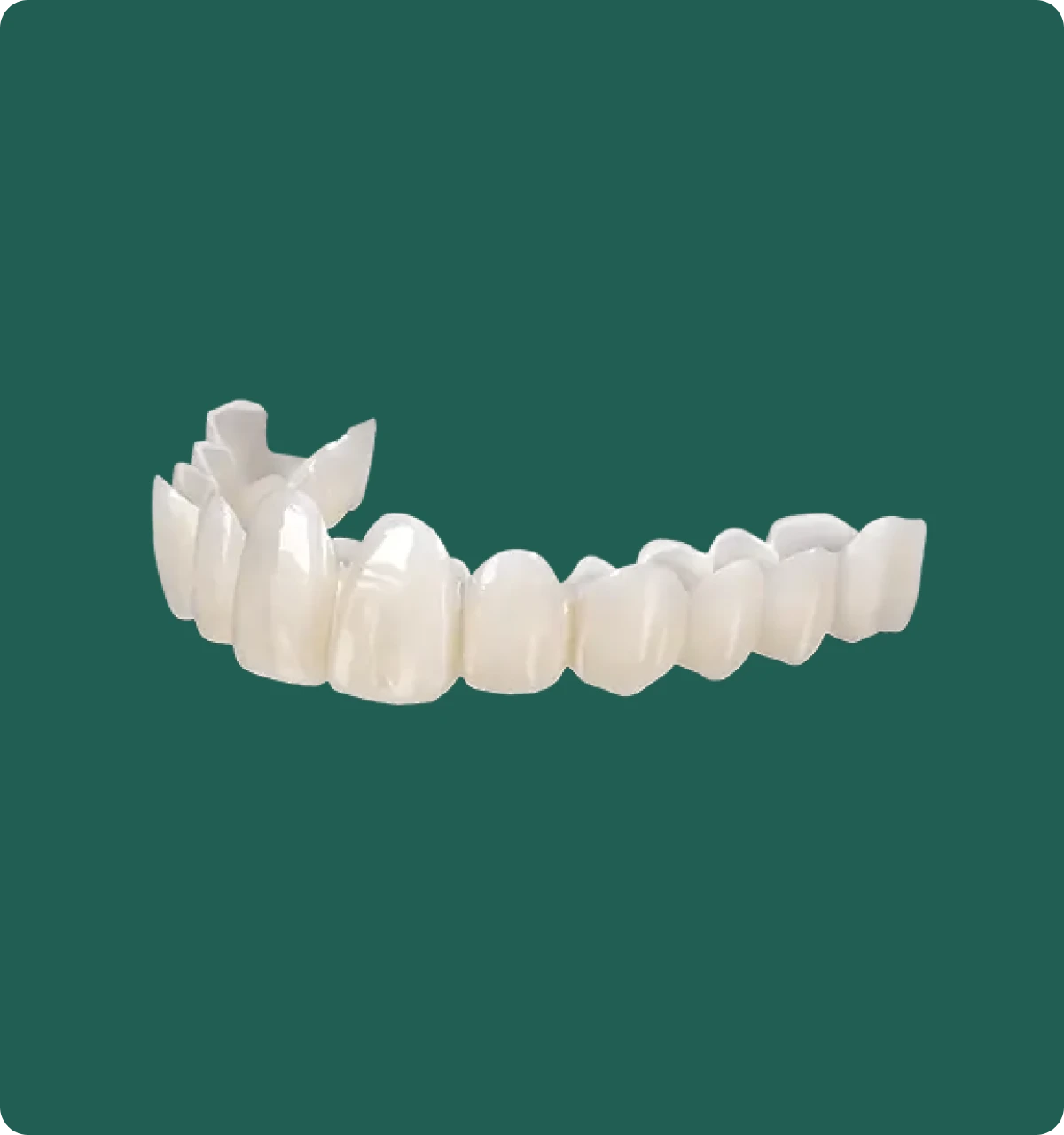 Snap-On Smile appliance shown on a dental model, demonstrating a natural, gap-free smile appearance.