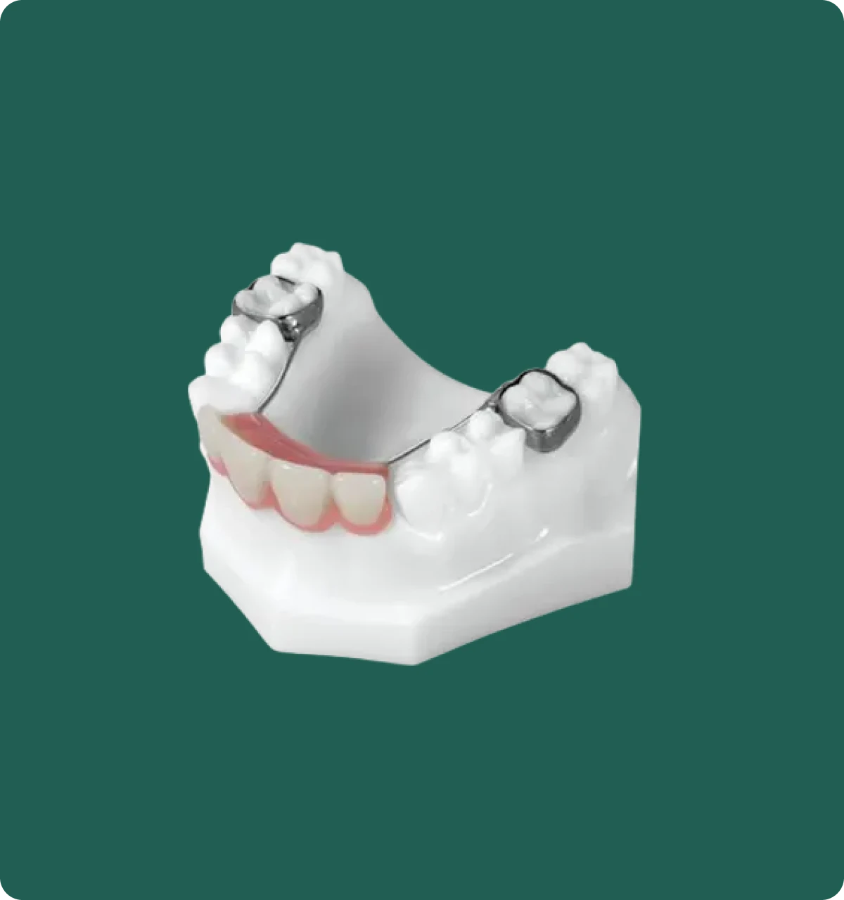 Close-up of a stainless steel band and loop space maintainer fitted on a dental model for a young patient.