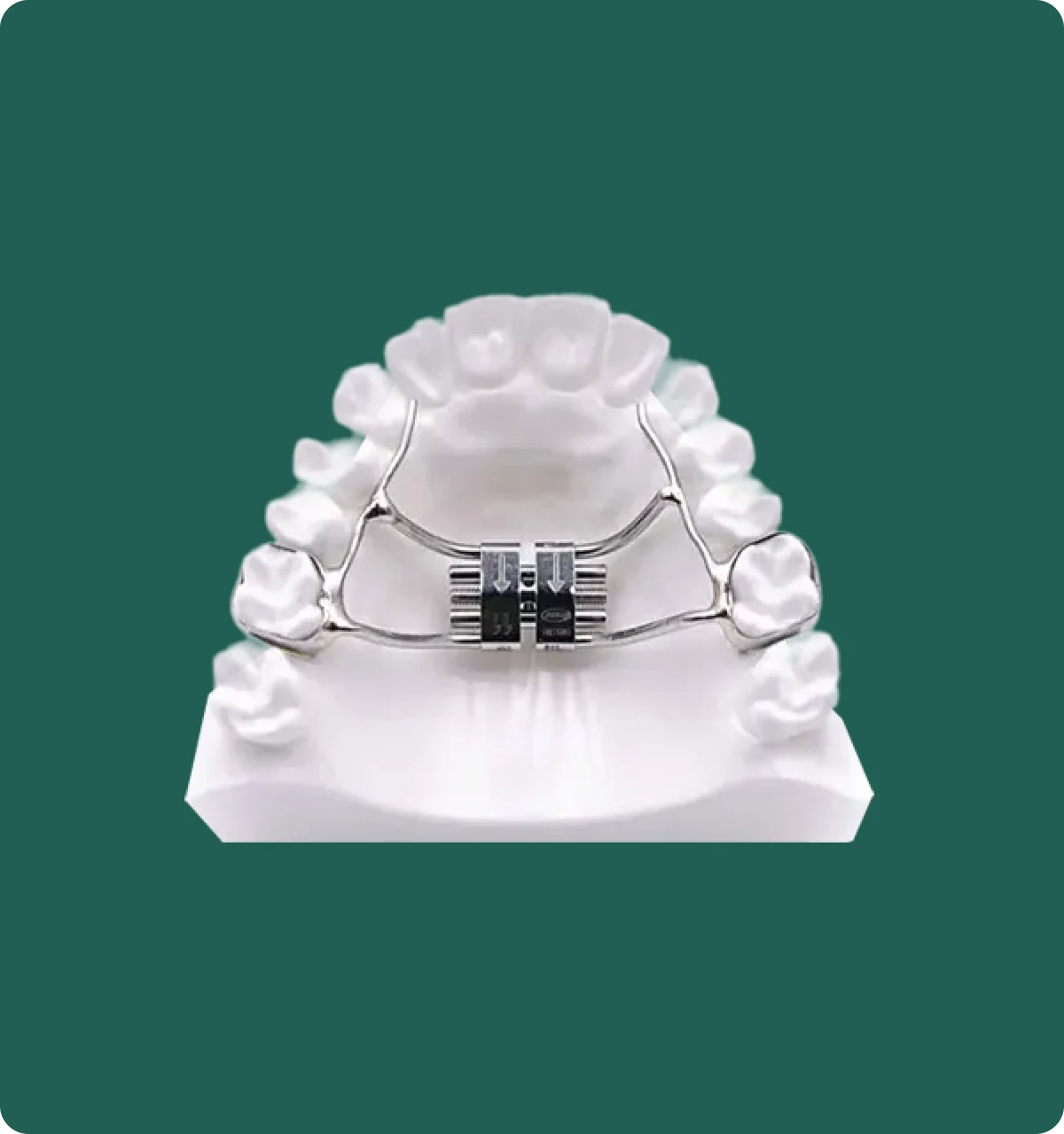 Close-up of an orthodontic palatal expander on a dental model, showing the expansion screw mechanism.