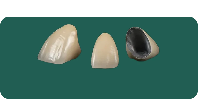 Porcelain fused to metal (PFM) crown on a dental model, showing the metal substructure layered with porcelain.
