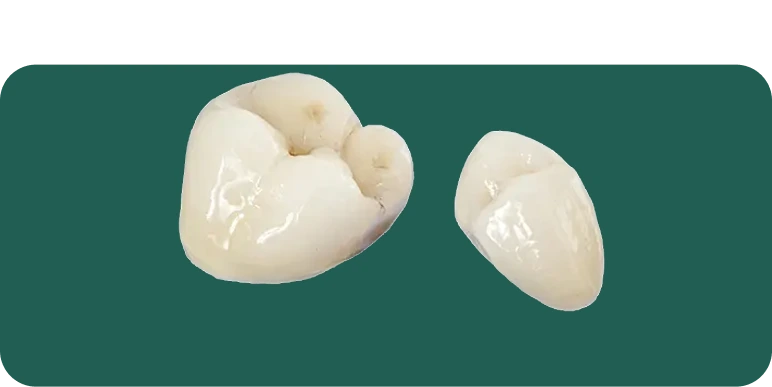 Porcelain fused to zirconia (PFZ) crown on a dental model, showing layered porcelain over a zirconia core.