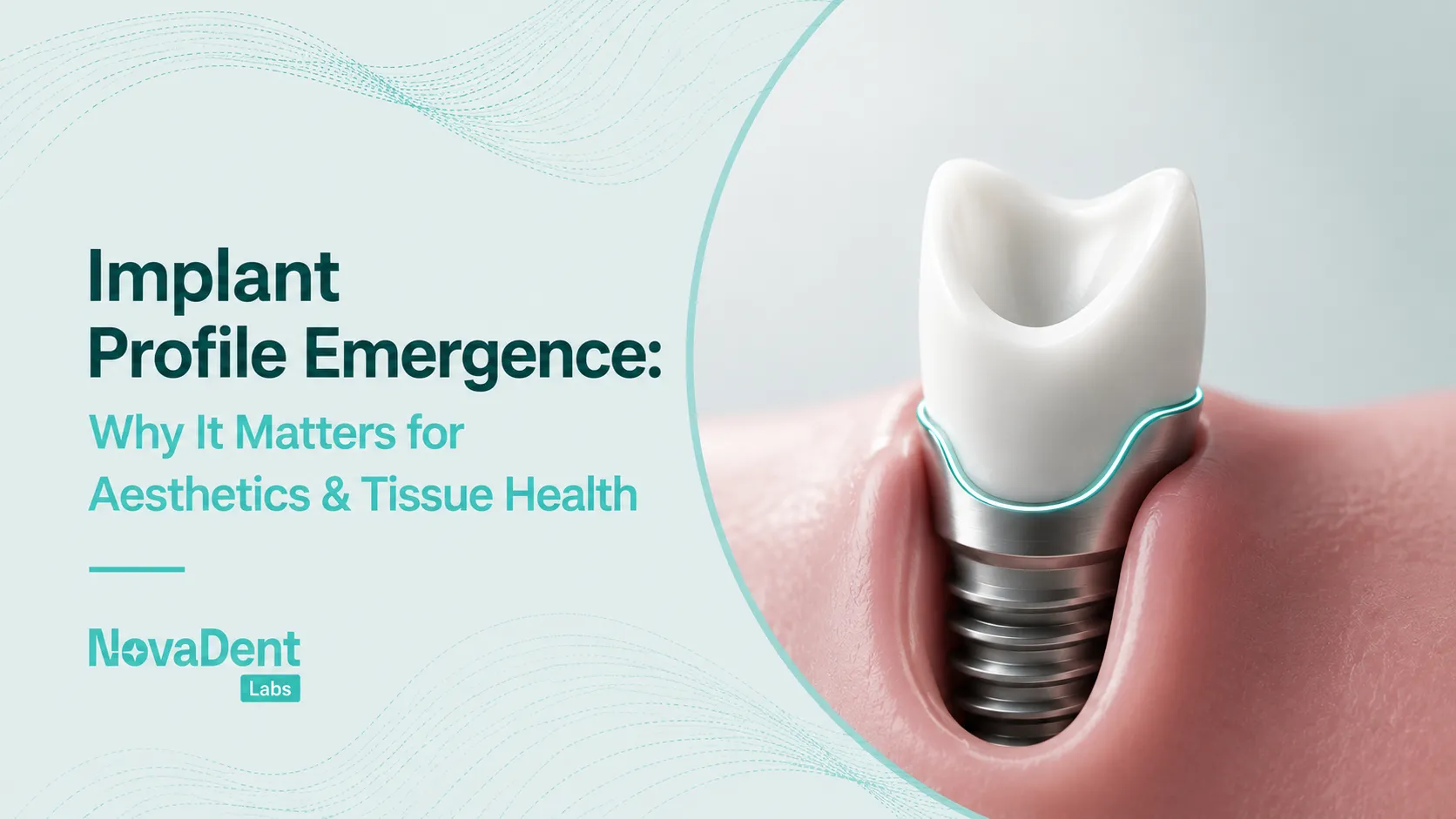 Diagram of an implant crown's emergence profile shaping the gum tissue around a dental implant