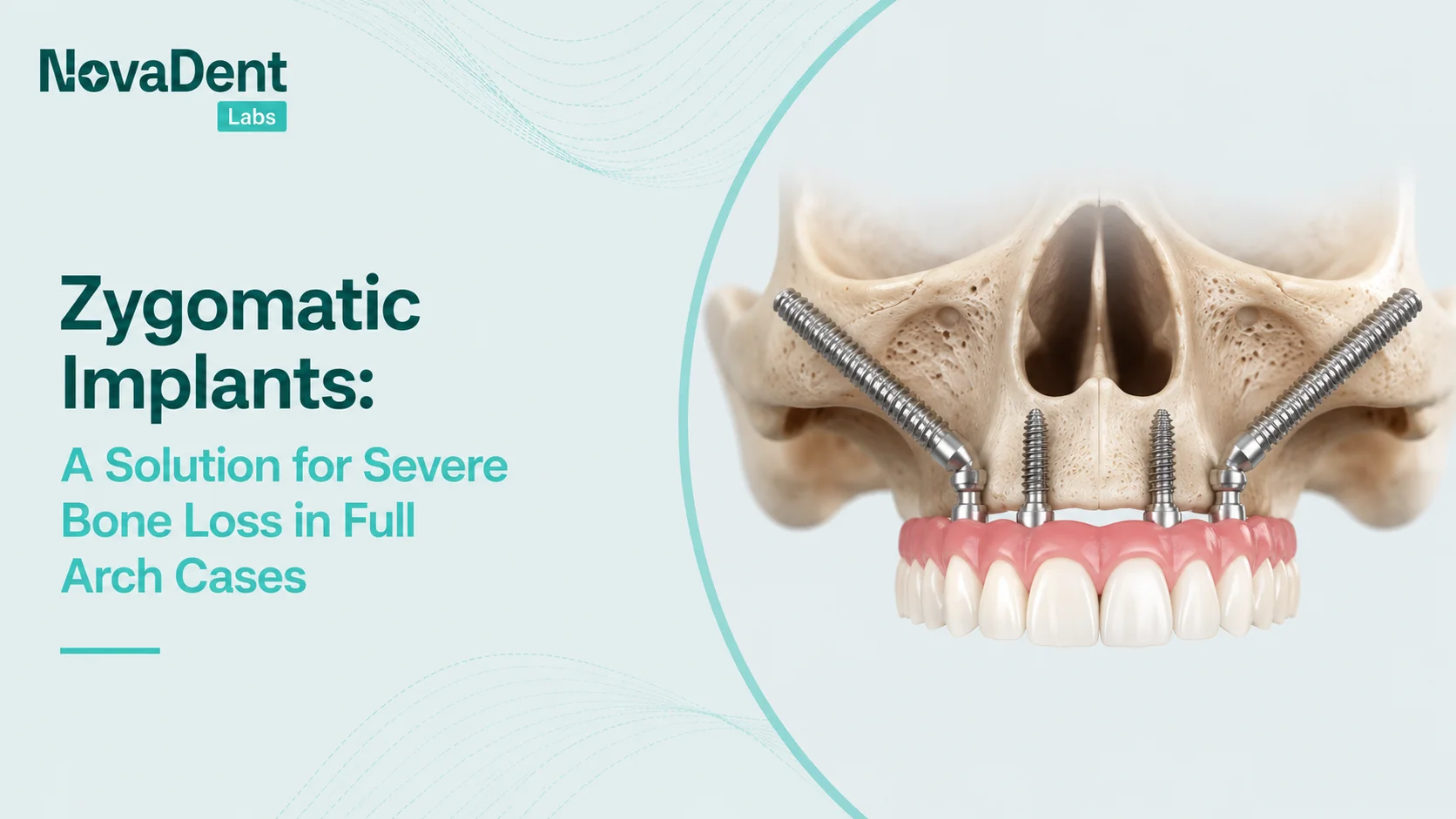 Illustration of zygomatic implants anchored into the cheekbone to support a full arch restoration