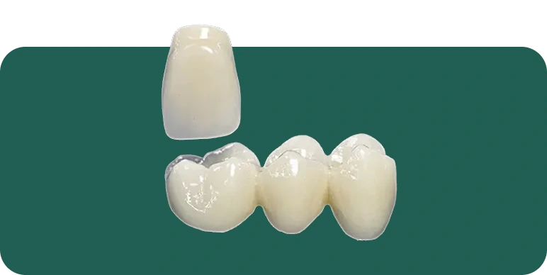 IPS e.max crown on a dental model, showing the lithium disilicate ceramic's natural translucency.