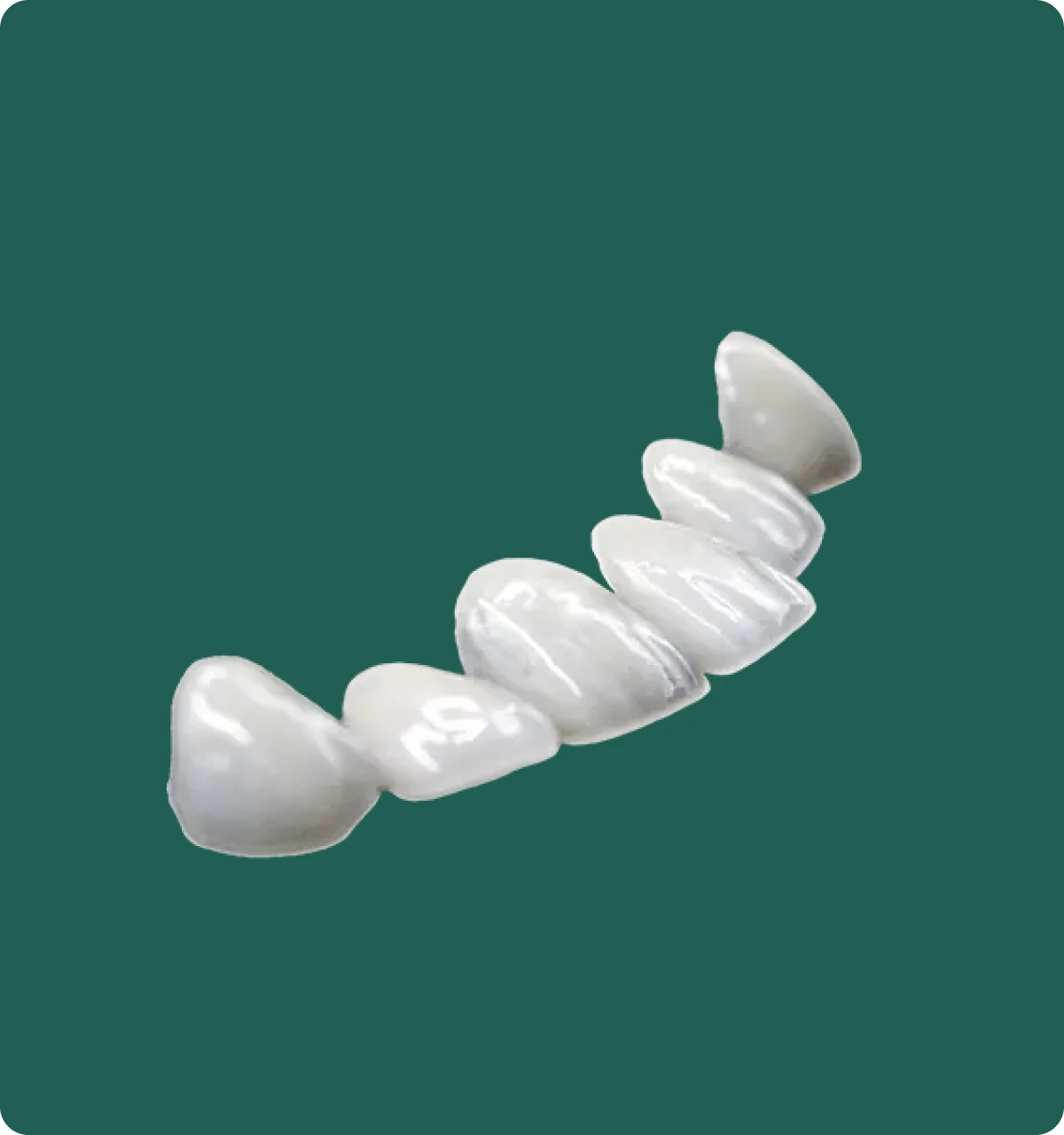 Set of IPS e.max veneers arranged by shade, demonstrating a range of Vita shade translucency options.