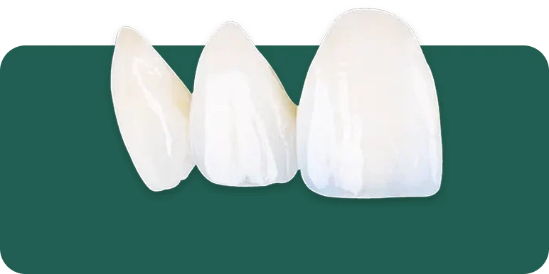 Close-up of an IPS e.max veneer held near natural teeth, showing its light-reflecting, enamel-like translucency.
