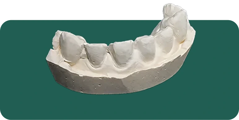 IPS e.max veneer fitted on a dental model, illustrating its bio-compatible lithium disilicate glass-ceramic composition.