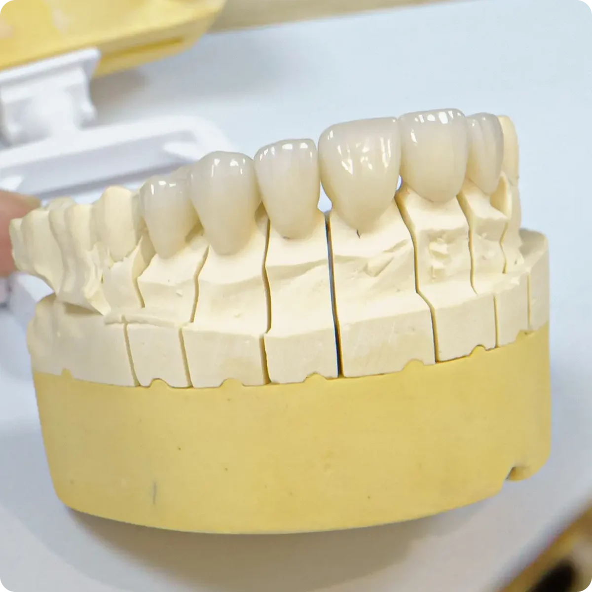 Dental model fitted with IPS e.max veneers, demonstrating a natural-looking cosmetic smile result.