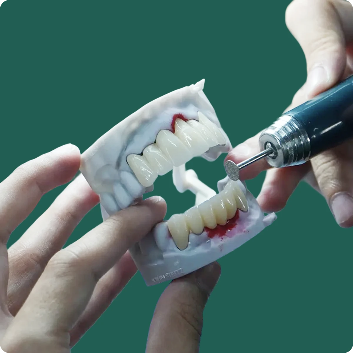 Close-up of an IPS e.max crown on a model, highlighting its translucency and shade matching.