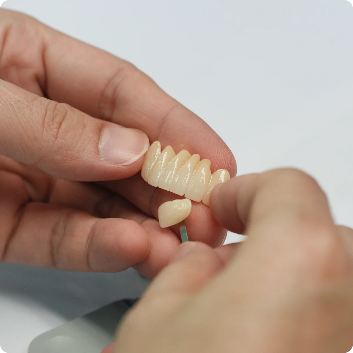 Zirconia dental crown fitted on a model, showing a metal-free margin at the gumline.