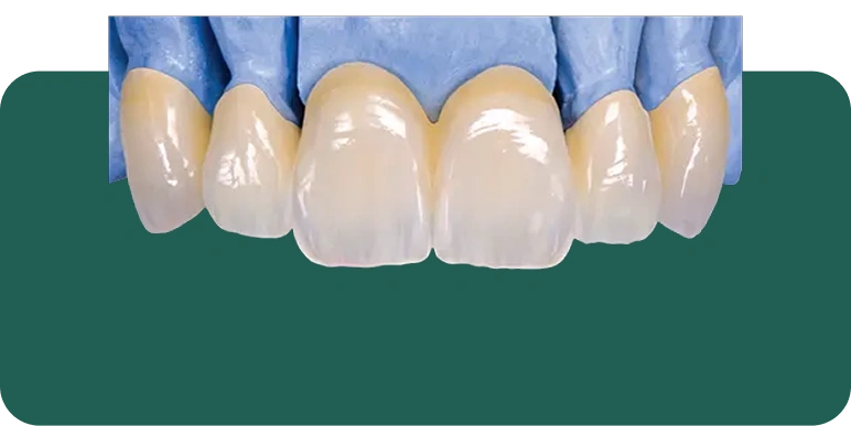 Ultra translucent monolithic zirconia crown showing lifelike light transmission similar to natural enamel.