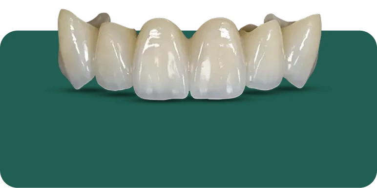 Ultra high-strength monolithic zirconia crown on a dental model, showing its dense, opaque structure.