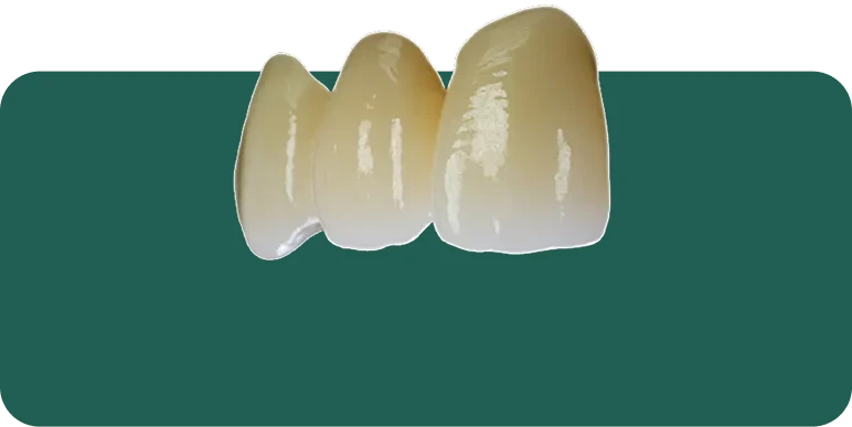 Multilayer zirconia restoration showing graduated shading from the gumline to the incisal edge.
