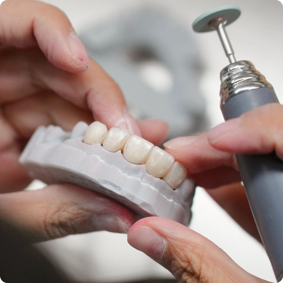 Full-mouth zirconia restoration on a dental model, demonstrating natural shading across multiple teeth.