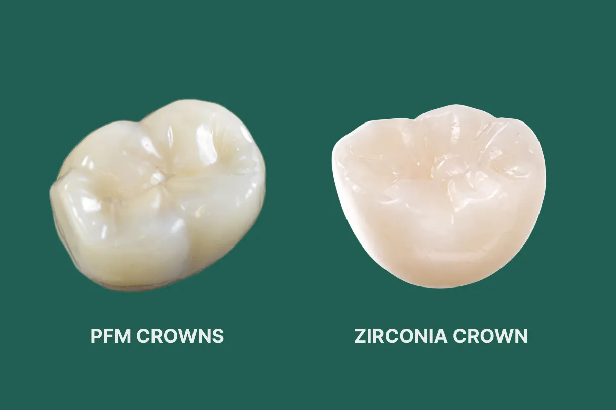 Porcelain-fused-to-metal crown and a zirconia crown displayed together for material comparison