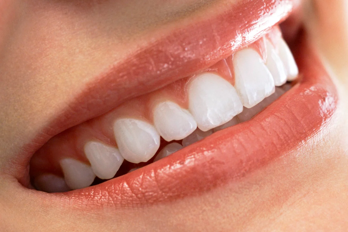 Patient's smile transformed through cosmetic dentistry with evenly shaped, whitened teeth