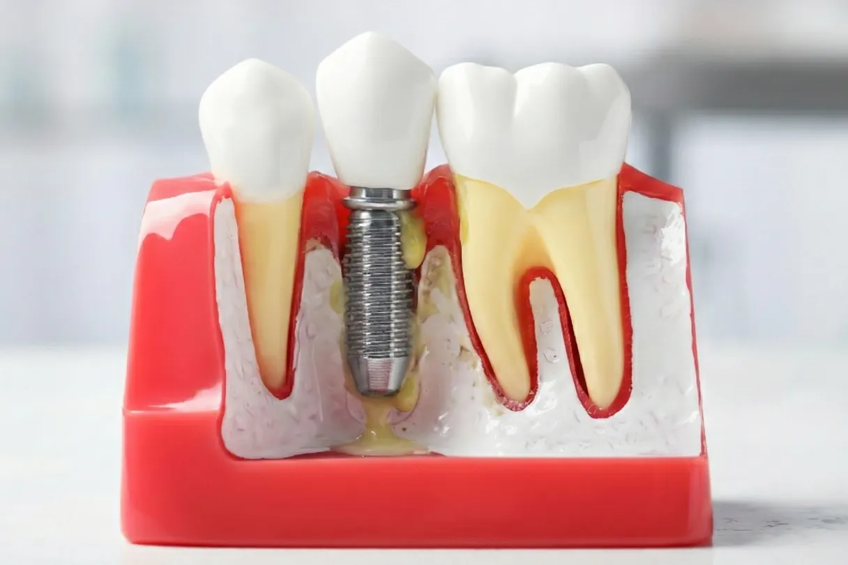Failed dental implant showing bone loss around the fixture due to complications