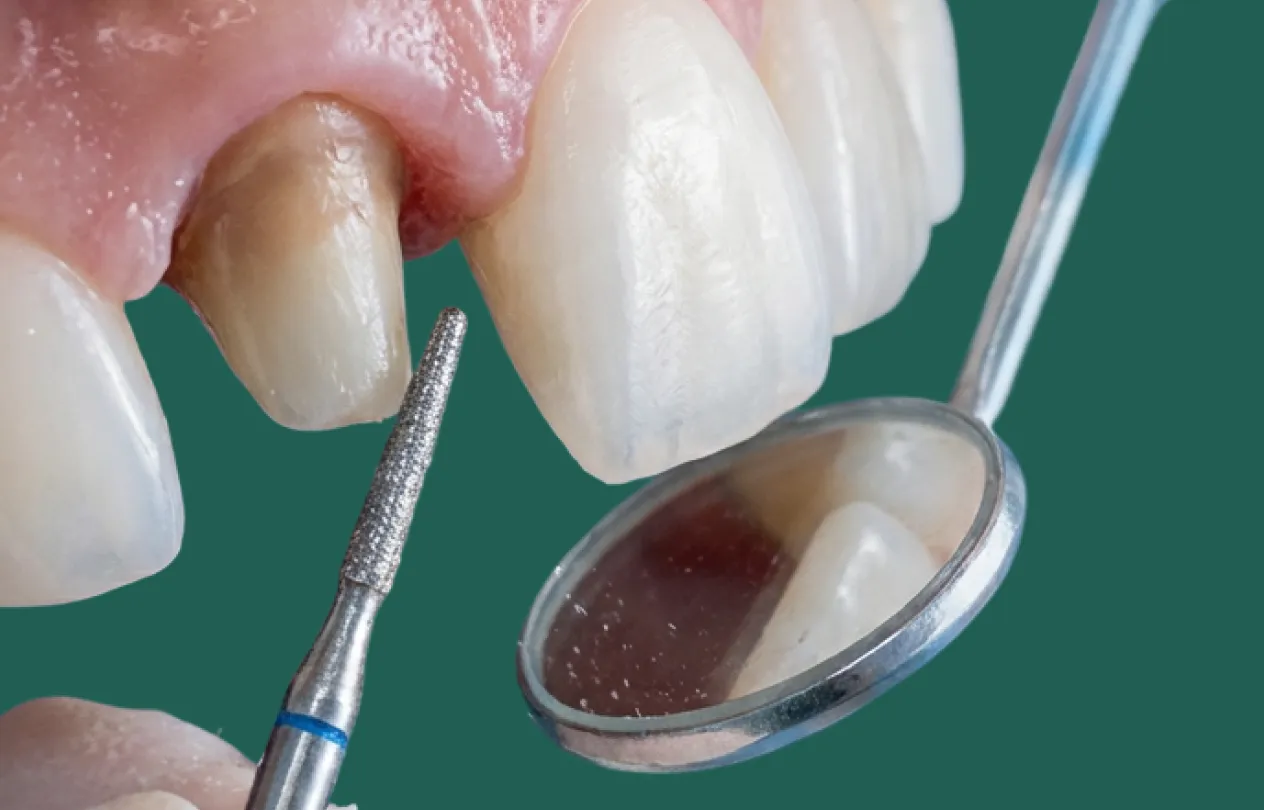Anterior crowns fitted on front teeth to restore a natural, symmetrical smile