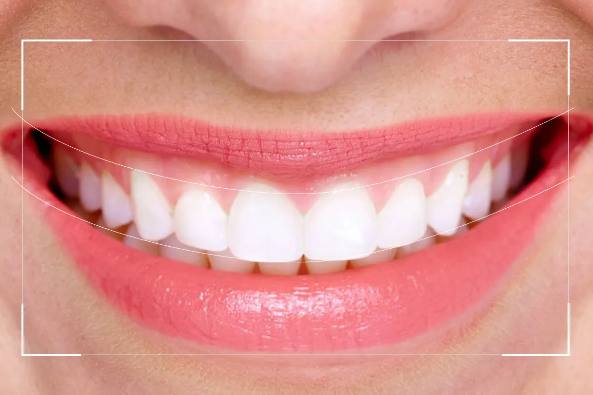 Digital smile design software mockup showing a planned new smile over a patient's photo