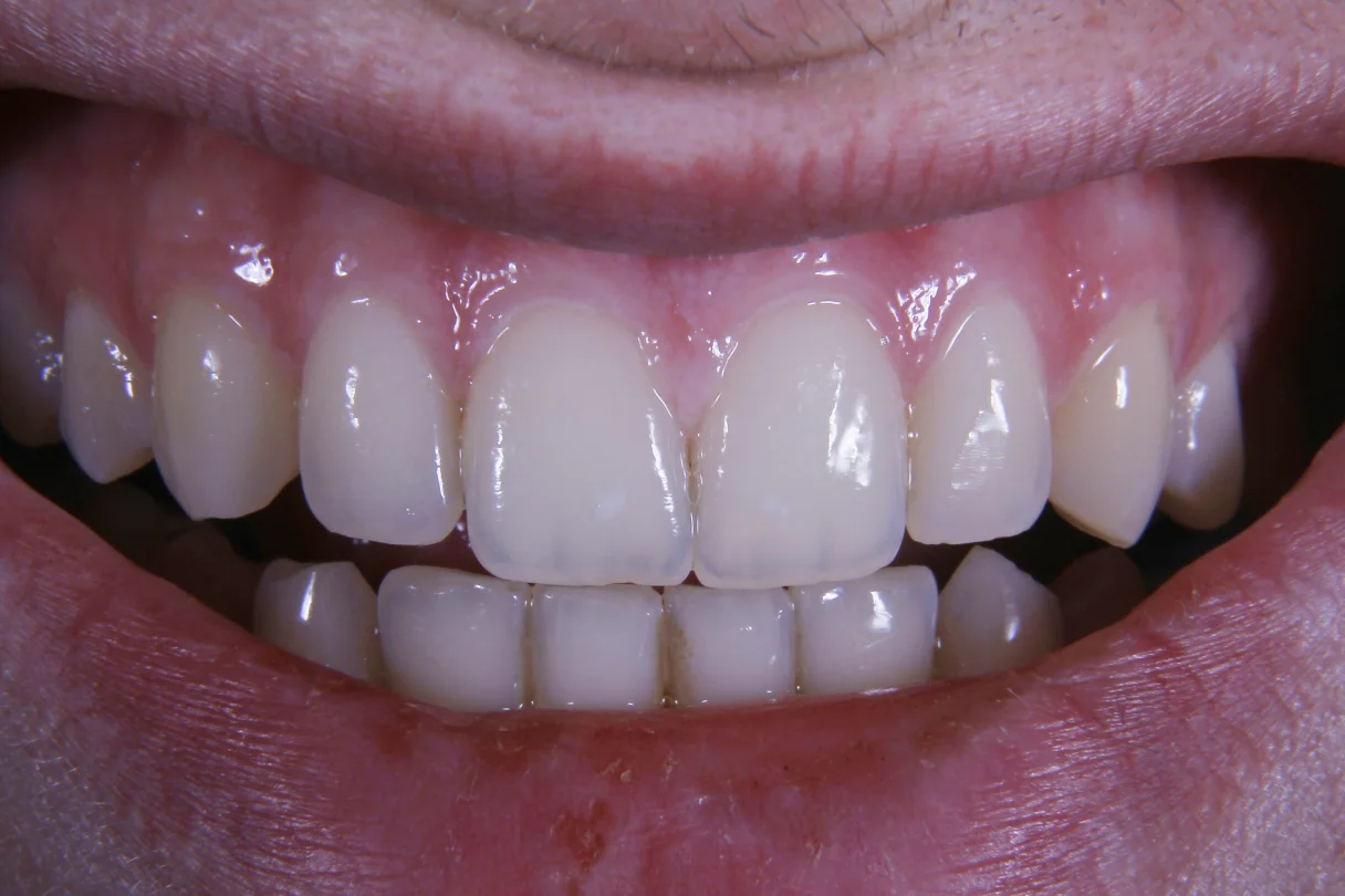 Teeth whitening tray with gel applied to a set of upper teeth