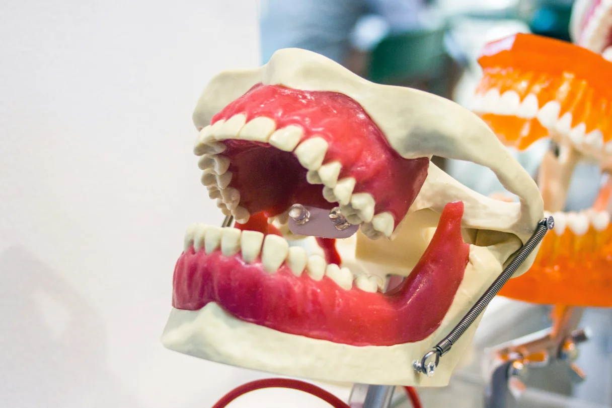 Implant-supported denture designed to be worn all day and night for comfort