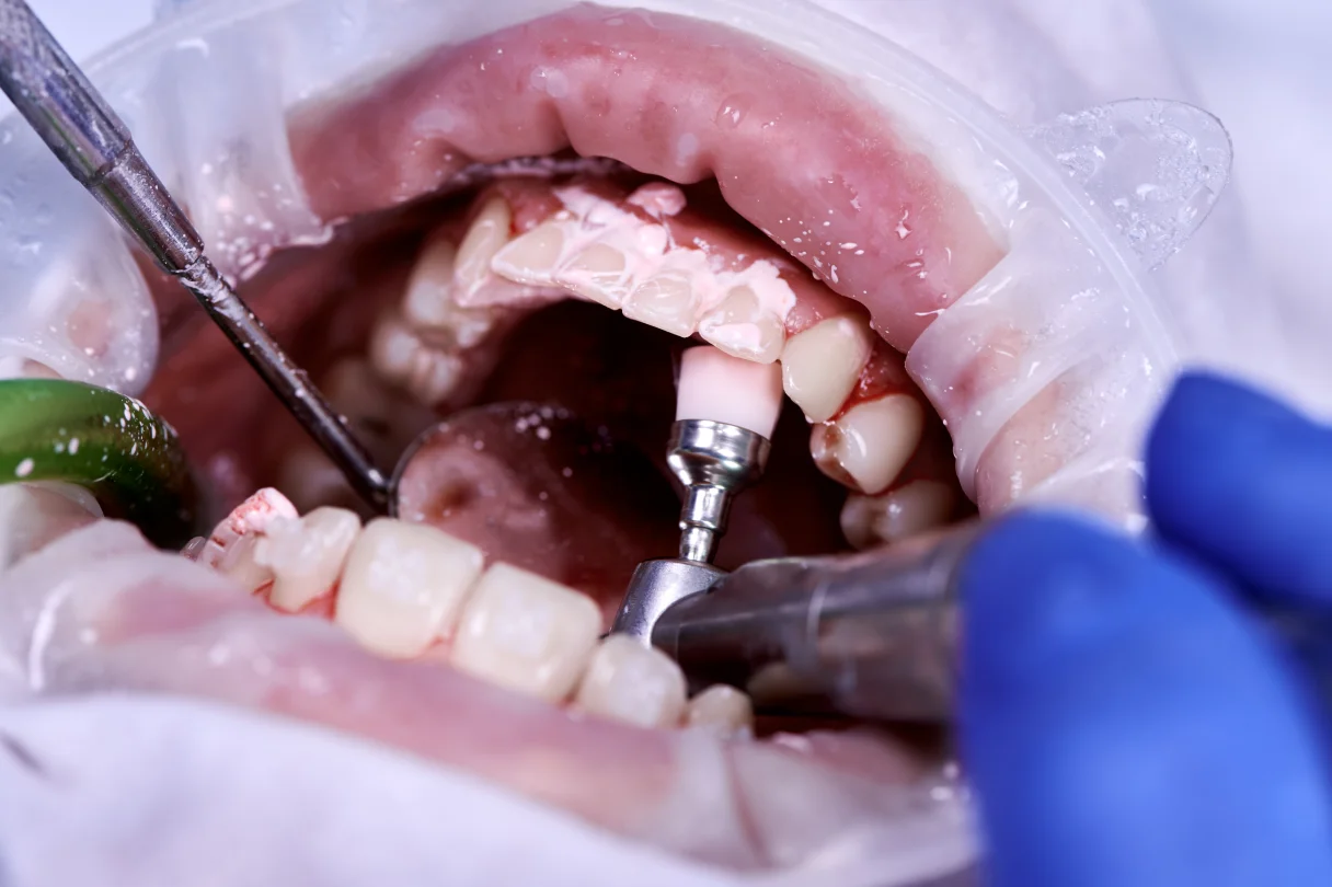 Digital scan and treatment plan for a complex edentulous case using implant-supported restoration