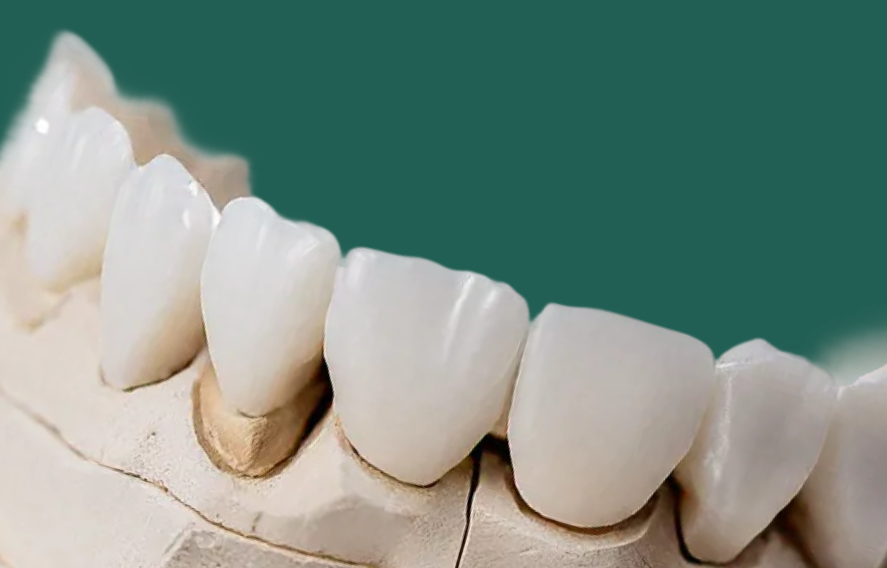 Zirconia crown shown with thickness measurements marked for a scanner-first digital workflow