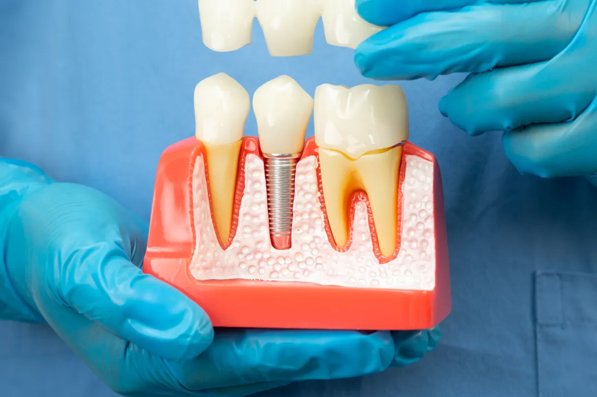 Bone graft material placed in the jaw to rebuild volume before implant placement