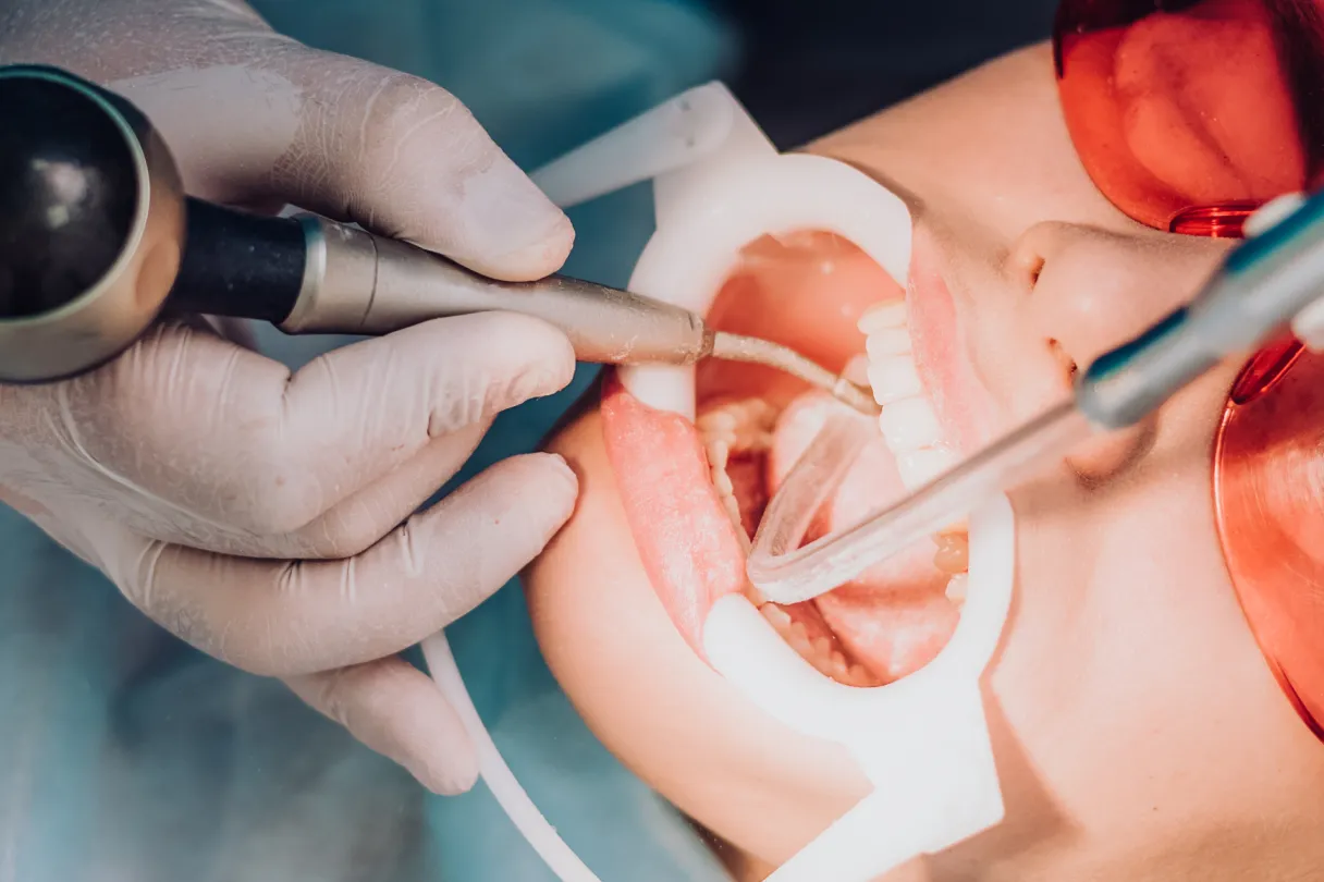 Wash impression being taken inside a denture base to capture accurate tissue detail