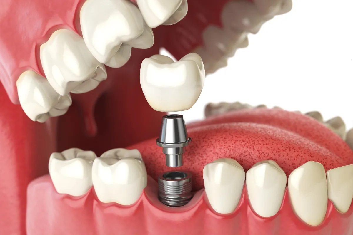 Dental implant model showing the fixture and crown used to illustrate implant cost and workflow